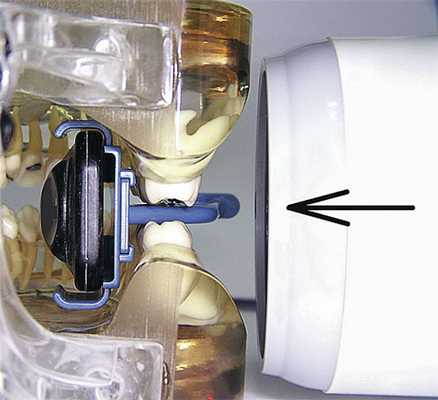 Рис. 5. Демонстрация положения позиционера в полости рта и направления луча при bitewing-съемке.