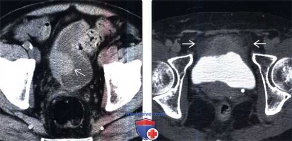 КТ, цистография при плоскоклеточном раке мочевого пузыря