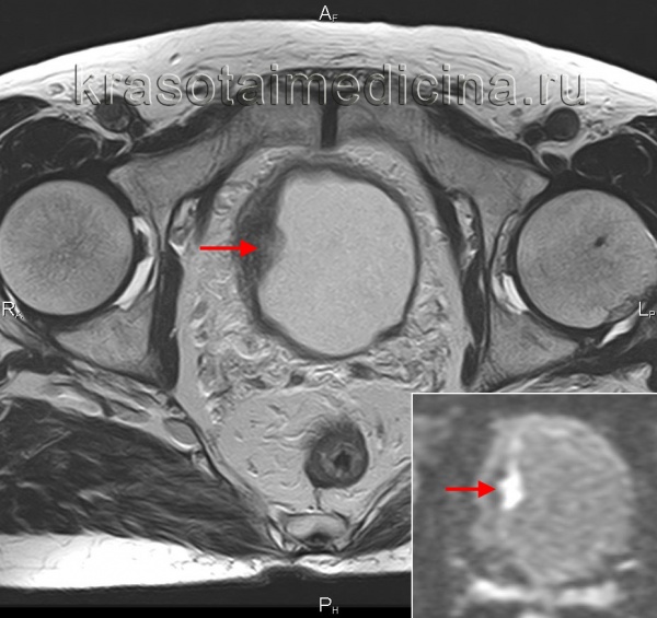 Рак мочевого пузыря