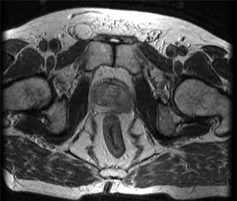МРТ (Т2-взвешенные изображения) картина поражения левой доли предстательной железы
