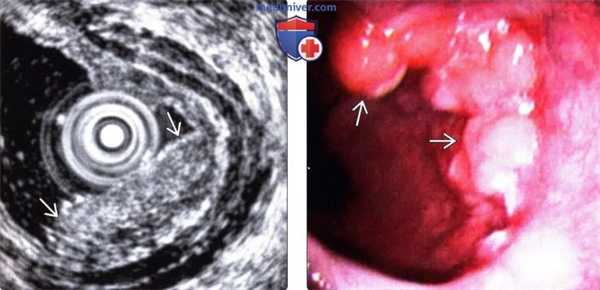 Рентгенография (эзофагография), КТ, МРТ, УЗИ при раке пищевода