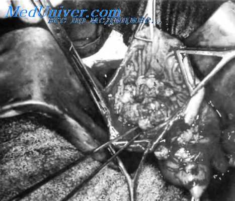 дуоденотомия при опухоли фатерова сосочка