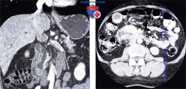 КТ, МРТ, УЗИ признаки рака ампулы фатерова сосочка