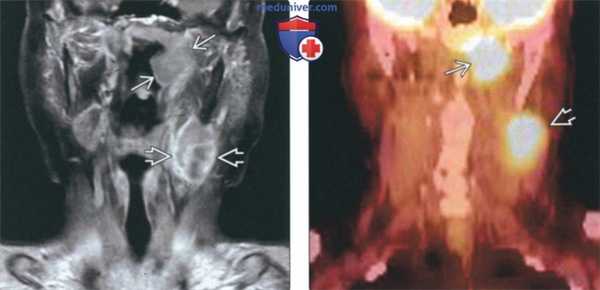КТ, МРТ при раке носоглотки