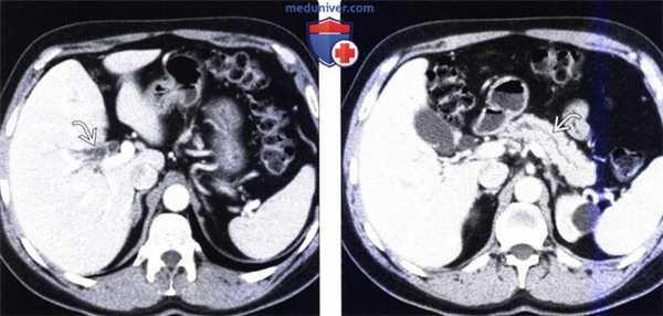 Рентгенограмма, КТ, МРТ, УЗИ при раке двенадцатиперстной кишки