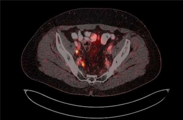 ПЭТ-КТ изображения больного М. с поражением тазовых лимфоузлов