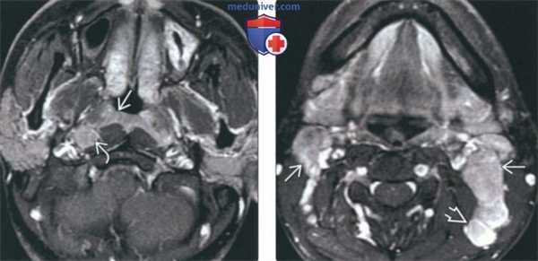 КТ, МРТ при раке носоглотки