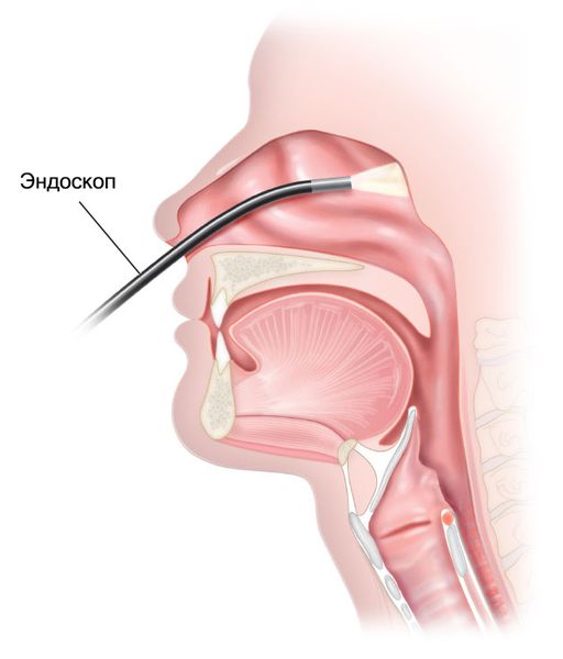 Эндоскопия носоглотки