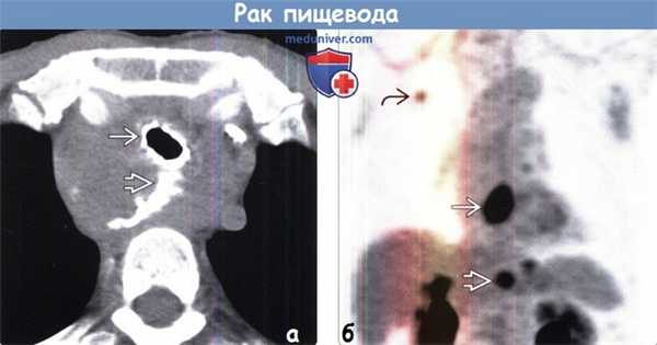 Рак пищевода на КТ и ПЭТ