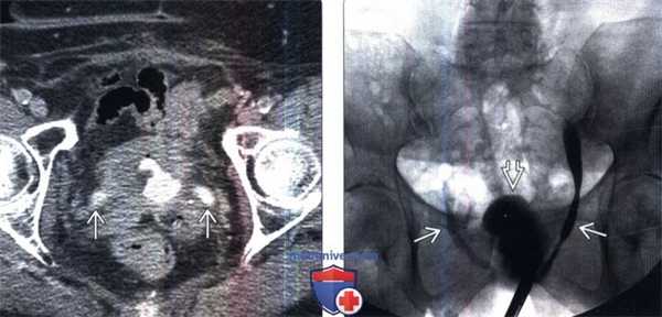 КТ, цистография при плоскоклеточном раке мочевого пузыря
