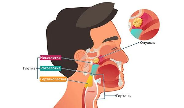 Рак носоглотки