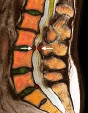 стеноз в пояснице в цвете