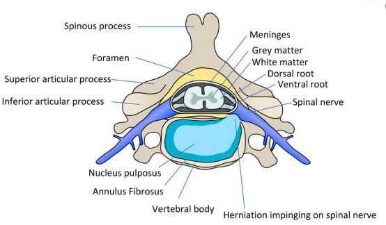 Межпозвонковая грыжа