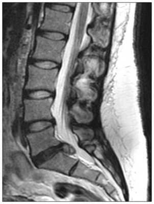 Межпозвонковая грыжа на КТ