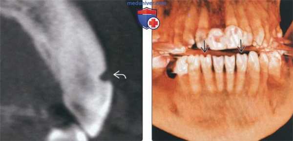 Рентгенограмма, КТ при сошлифовывании зубов (абразии)