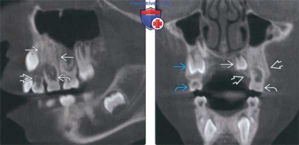 Лучевая диагностика сегментарной верхнечелюстной одонтодисплазии зубов