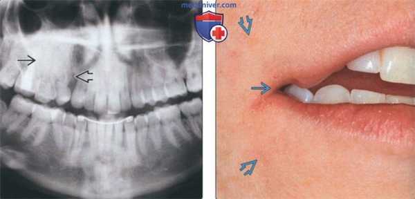 Лучевая диагностика сегментарной верхнечелюстной одонтодисплазии зубов