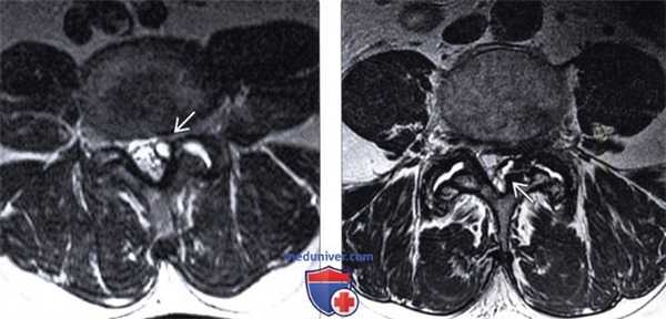 МРТ артропатии дугоотростчатых суставов поясничного отдела позвоночника