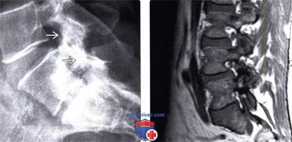 Рентгенограмма, МРТ артропатии дугоотростчатых суставов поясничного отдела позвоночника