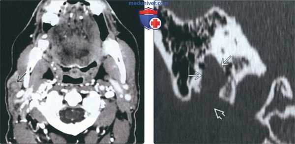 Лучевая диагностика шванномы околоушной железы