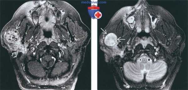 Лучевая диагностика шванномы околоушной железы