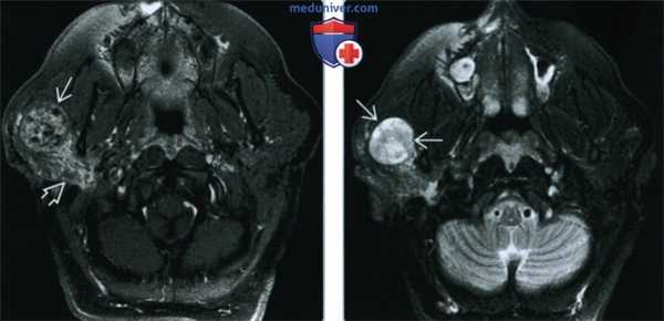 Шваннома пространства околоушной железы - лучевая диагностика