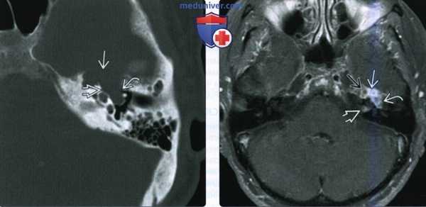 КТ, МРТ при шванноме интратемпорального лицевого нерва