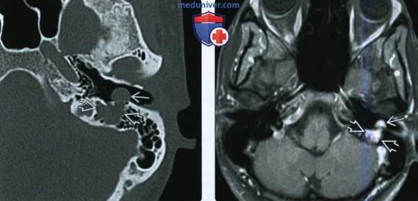 КТ, МРТ при шванноме интратемпорального лицевого нерва