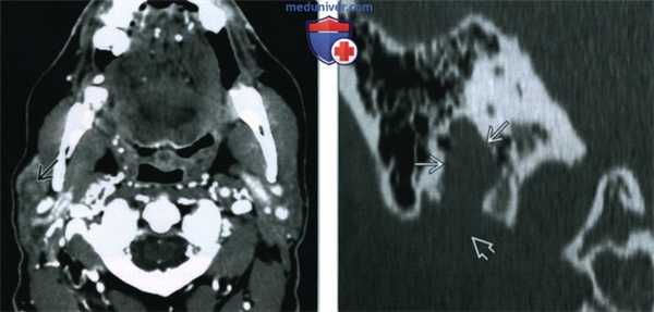 Шваннома пространства околоушной железы - лучевая диагностика