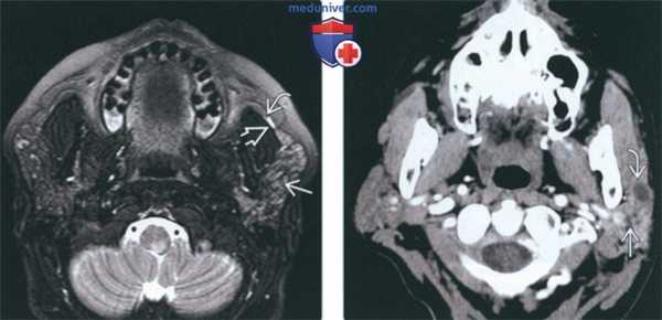 Лучевая диагностика воспаления околоушной железы