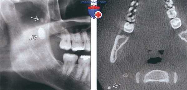 Лучевая диагностика сиалолита околоушной железы