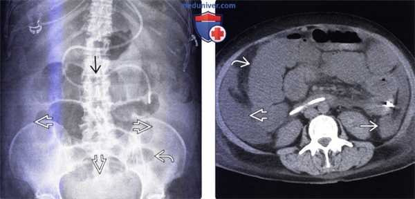 Лучевая диагностика илеуса