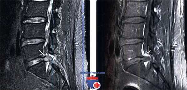 Лучевая диагностика рецидива грыжи межпозвонкового диска