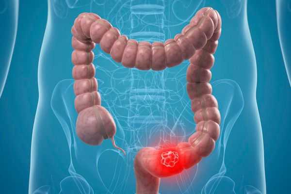 Аденокарцинома толстой кишки