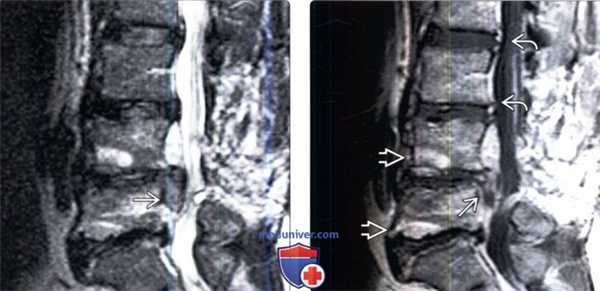 Лучевая диагностика рецидива грыжи межпозвонкового диска