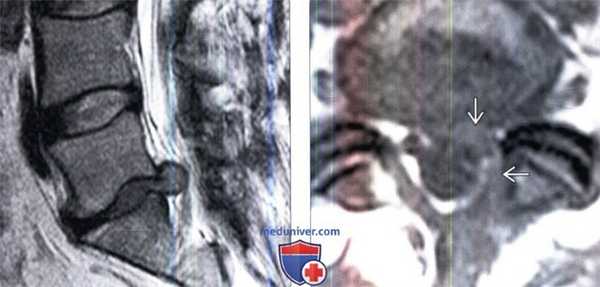 МРТ при неудачной операции на позвоночнике