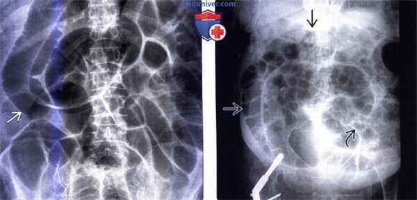 Лучевая диагностика илеуса