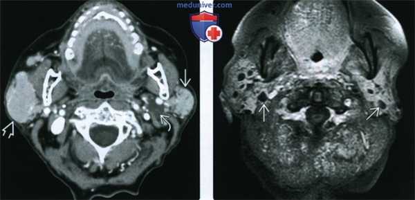 КТ, МРТ, УЗИ околоушной железы при синдроме Шегрена
