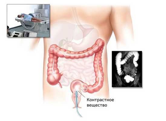 Ирригоскопия