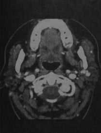 Снимки МРТ и КТ. Синдром Шегрена
