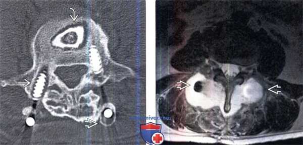 МРТ при неудачной операции на позвоночнике