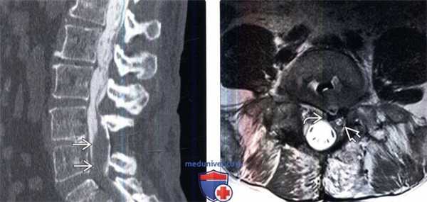 МРТ при неудачной операции на позвоночнике