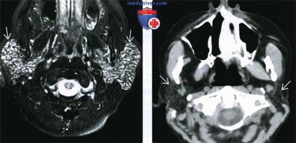 КТ, МРТ, УЗИ околоушной железы при синдроме Шегрена