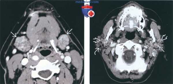 Лучевая диагностика синдрома Шегрена околоушной железы