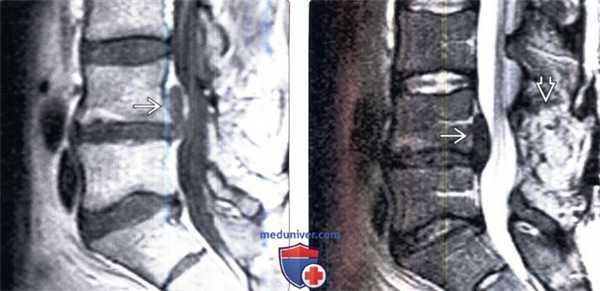 Лучевая диагностика рецидива грыжи межпозвонкового диска