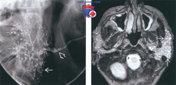 Лучевая диагностика синдрома Шегрена околоушной железы