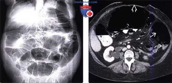 Рентгенограмма, КТ при синдроме Огилви (илеусе толстой кишки)