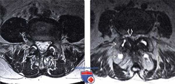 МРТ артропатии дугоотростчатых суставов поясничного отдела позвоночника