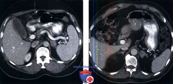 КТ, МРТ, ПЭТ, УЗИ при метастазах в надпочечники