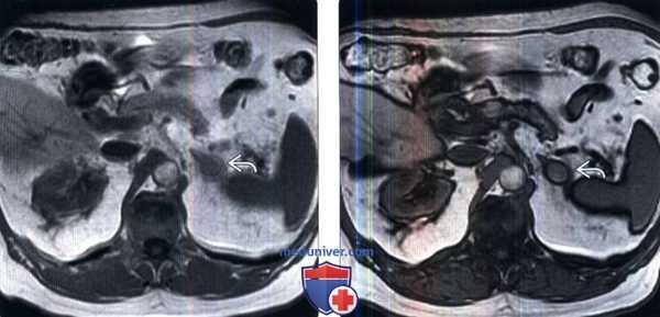 КТ, МРТ, ПЭТ, УЗИ при метастазах в надпочечники